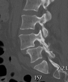 Degenerative Spondylolithesis CT 1